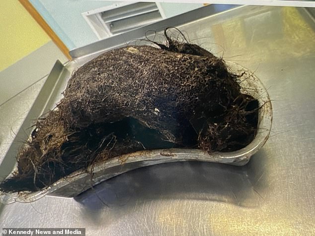 Surgeons spent five hours pulling out the melon-sized mass, which had consequently left Erin anaemic and suffering with multiple nutritional issues