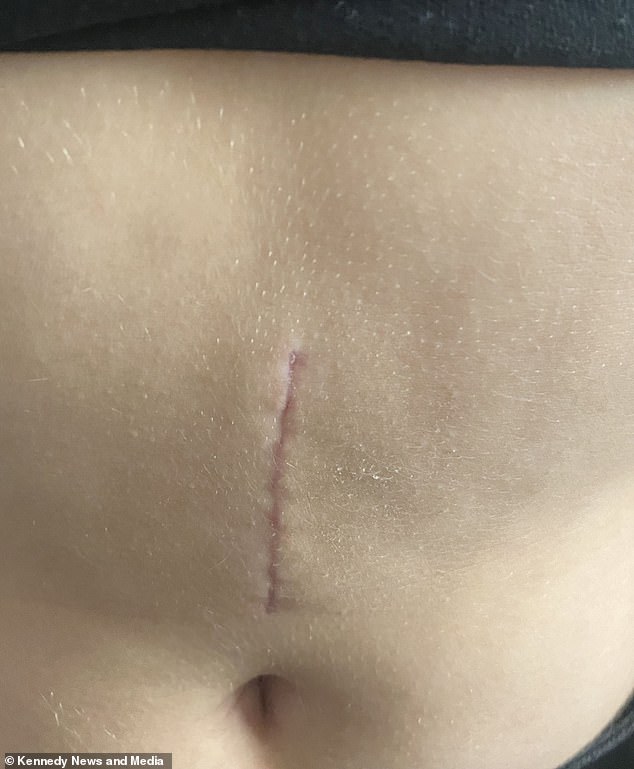 Erin was rushed to Bristol Children's Hospital where a surgery confirmed a giant, 8.3-inch hairball was stuck inside the unsuspecting teen's stomach