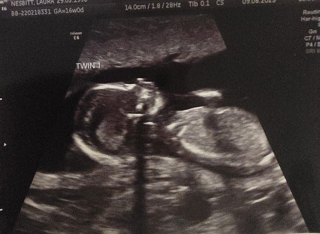 The twins will have more of a fighting chance of survival if her mother has laser treatment