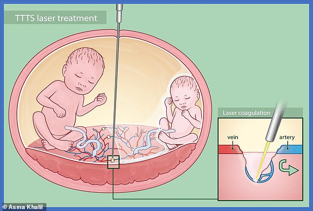 Asma Khalil, Professor of Obstetrics and Maternal Fetal Medicine at St George's, said: 'The laser surgery is not a risk-free procedure. It can trigger early birth or a miscarriage'