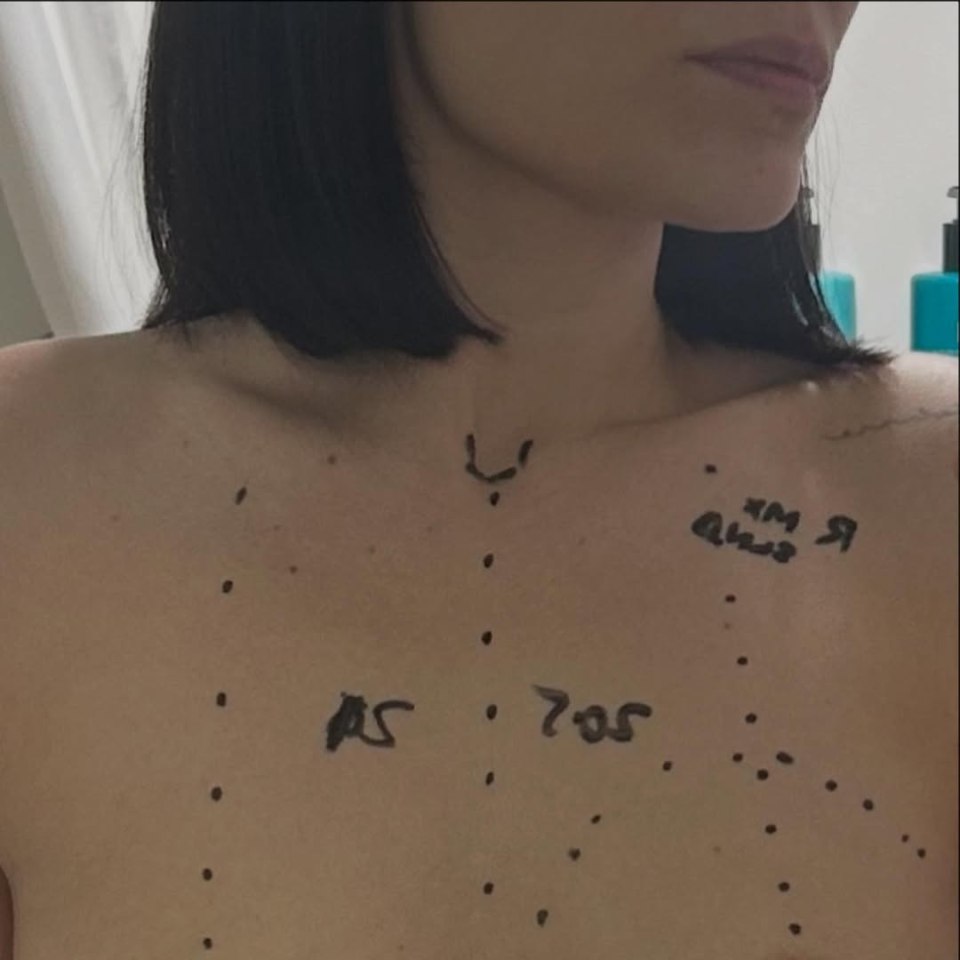 Close-up of a person's chest with markings indicating surgery for breast cancer.