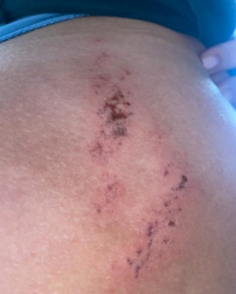 Second-degree burns on a woman's thigh caused by shapewear.