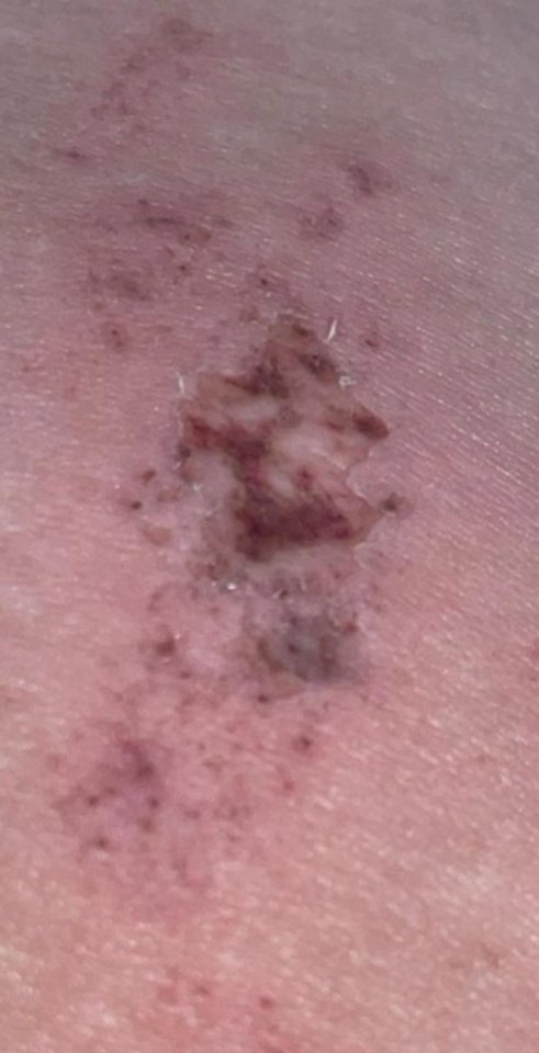 Close-up image of second-degree burns on skin.