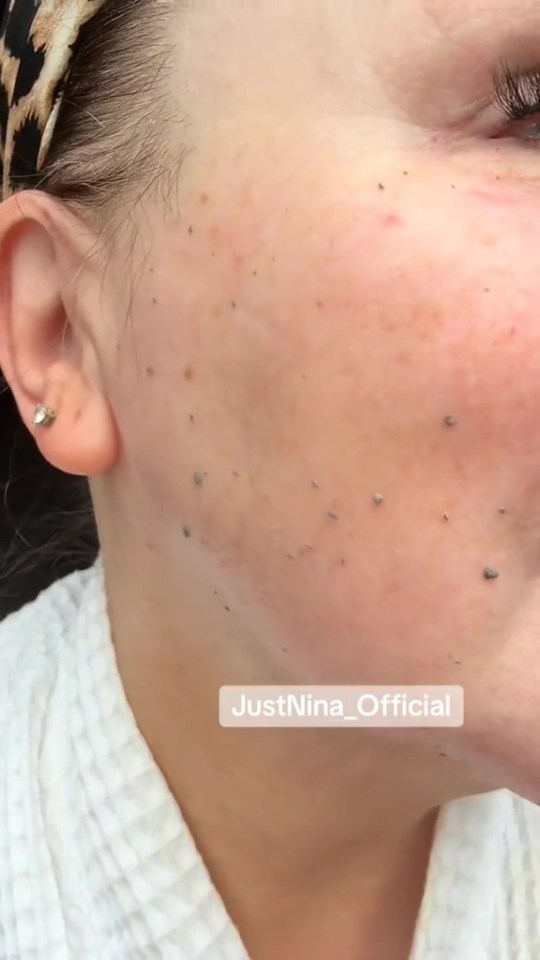 Close-up of a woman's face with small dark dots on her cheek.