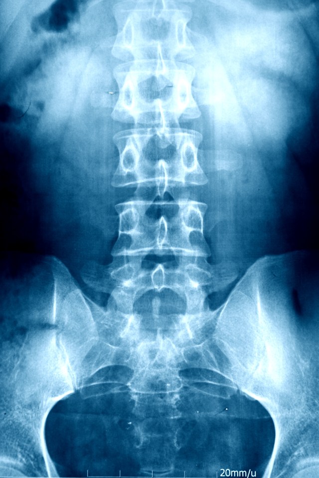 X-ray of vertebrae.