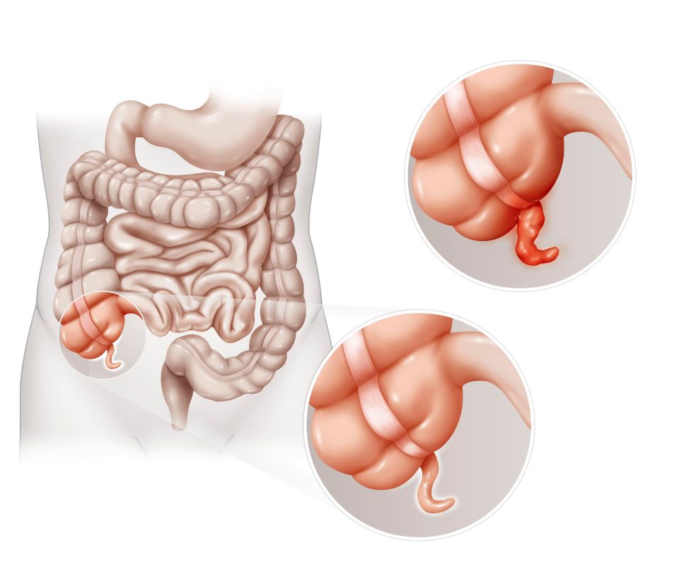 Illustration of appendicitis.