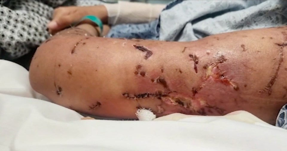 Severe dog bite wounds on a 17-year-old's arm.