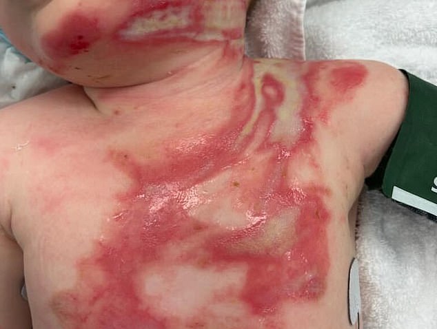 Baby Luka still requires regular surgery on his horrific burns