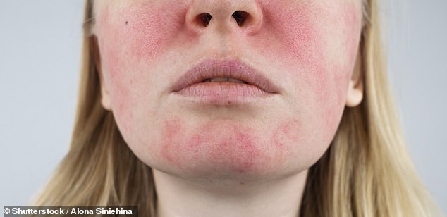 Research has found a protein called LL 37 ¿ which helps with wound healing ¿ is overly active in people with rosacea and destabilises the outer skin barrier, making it sensitive to triggers