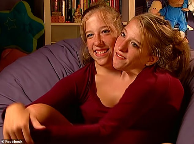The siblings, 35, from Minnesota, are one of only a few sets of dicephalic twins in history