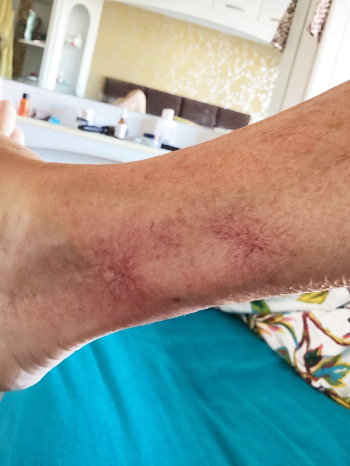 Close-up of ankle with thread veins.