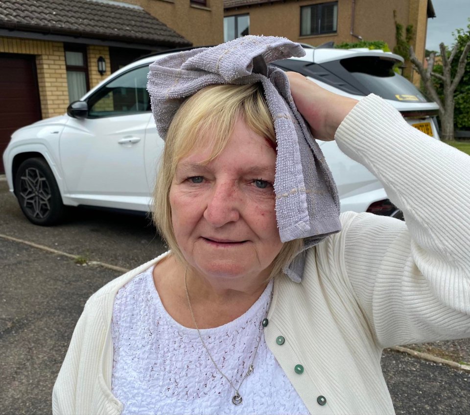 Woman with a head wound after being attacked by a seagull.