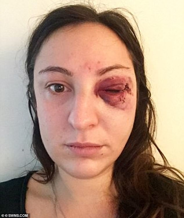 The shocking ambush (pictured, her injuries) has left her with an array of physical health problems, including permanent scarring and breathing issues