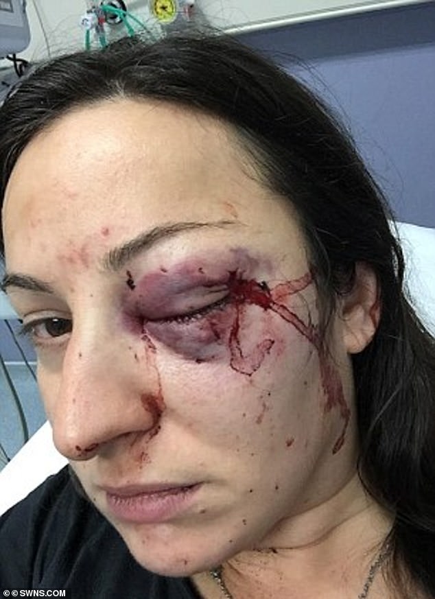 But Ms Martin did not realise the youths had overheard the encounter - and when she left the store, they surrounded her and sprayed her with a drink. After threatening to call the police, she was punched in the face (pictured, her injuries)