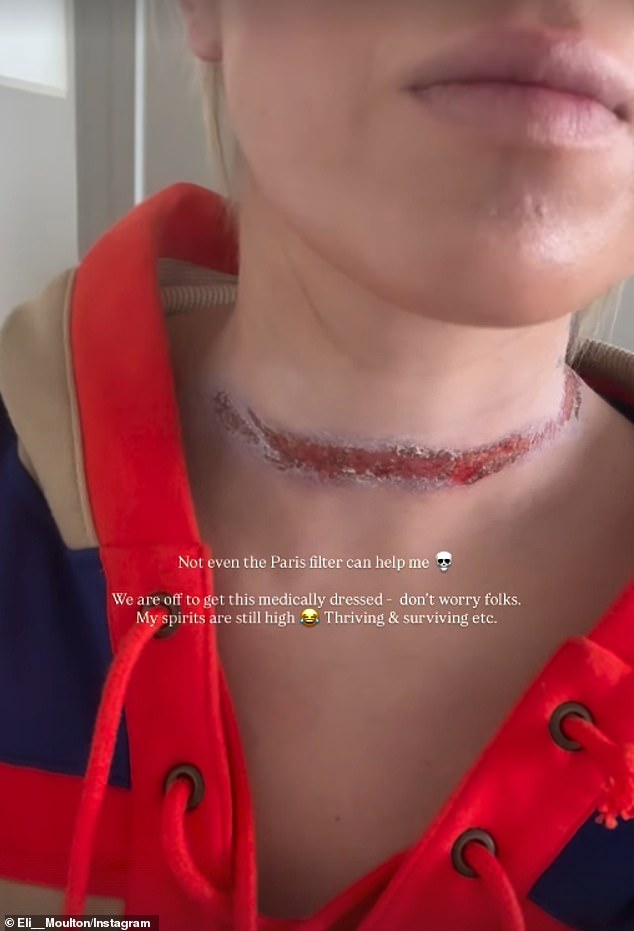 She rushed to hospital following the incident and required medical treatment for a severe friction burn around her neck