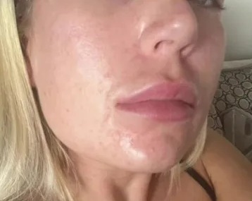 Before and after photos showing skin improvement after using beef tallow.