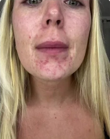 Before and after photos showing skin improvement after using beef tallow.