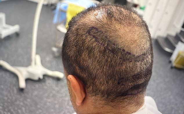 The top of the head of the healthcare provider, 60, from Kent who two unsuccessful surgeries
