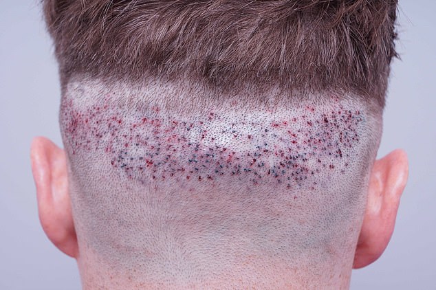 This is the back of the head of a single engineer 32 who had a botched hair transplant surgery