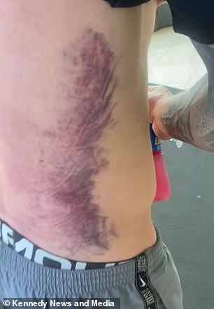 He was left with horrific bruising after hitting the water