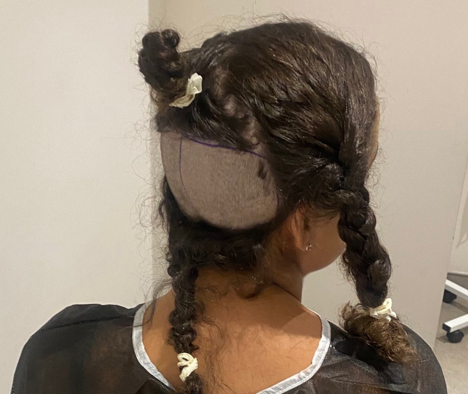 Shaved head of a person with hair in braids, showing donor area for hair transplant.