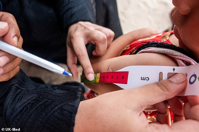 Medical professionals in Gaza can check for malnutrition with a 'MUAC score' - a measure of arm circumference
