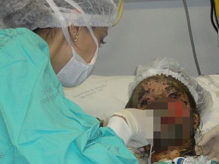 A woman with severe burns receives medical attention in a hospital bed.