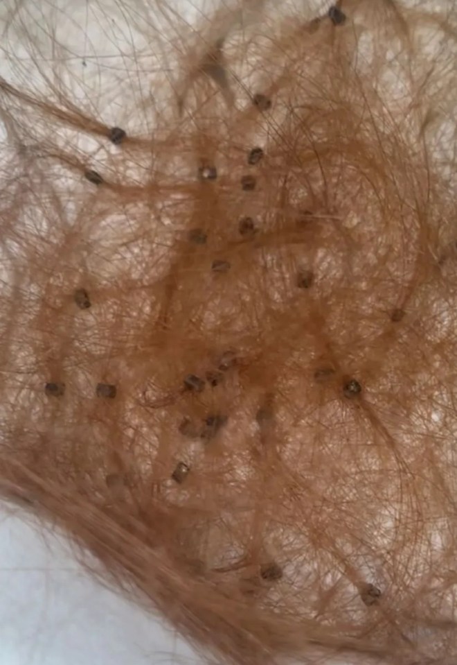 Close-up of hair with many small dark specks.