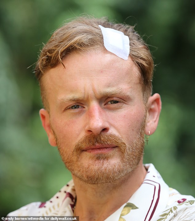 Former demolition worker Louis told the Daily Mail he thought he had been attacked by acid, having experienced a burning sensation on his face