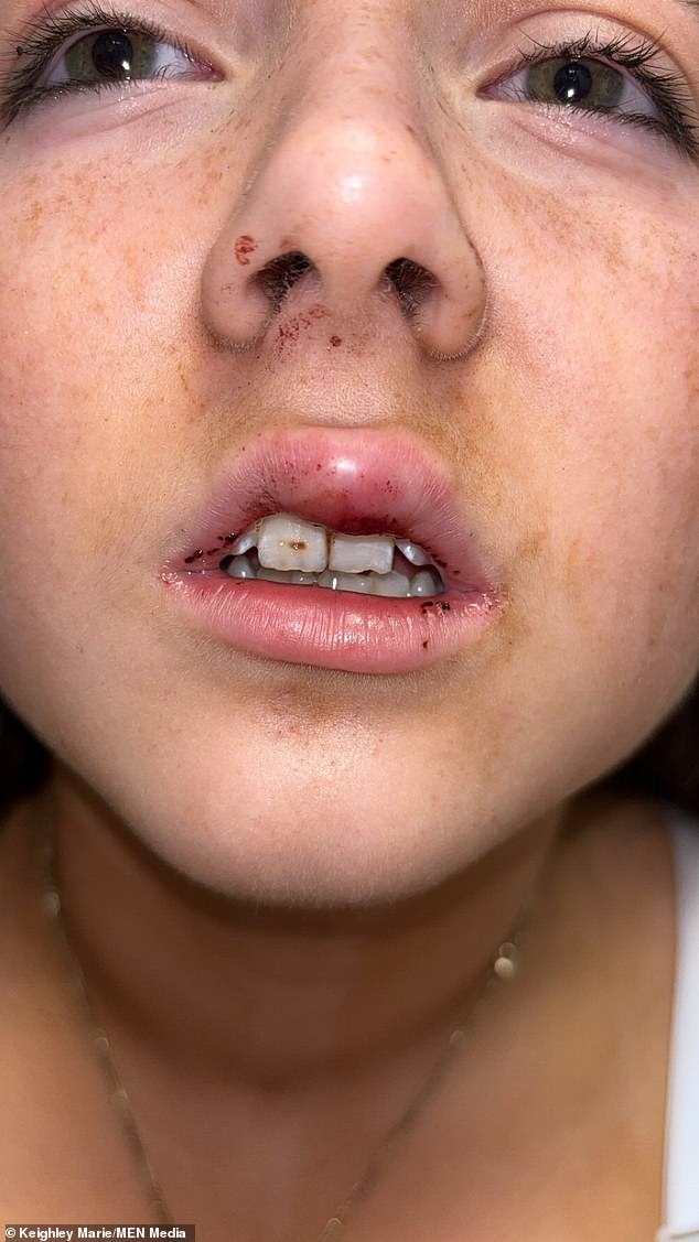 Olivia suffered swelling, scars and chipped teeth, as well as injuries to her back, neck and legs