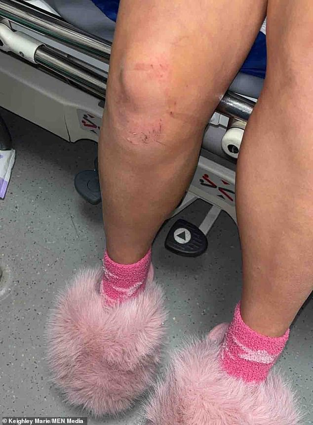 Olivia, who was also left with bruising and footprints on her legs, spent three nights in hospital in the aftermath of the assault