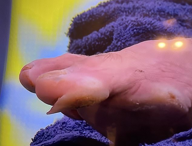 Cameras showed a close up of a large blister on Djokovic's toe as the star received treatment