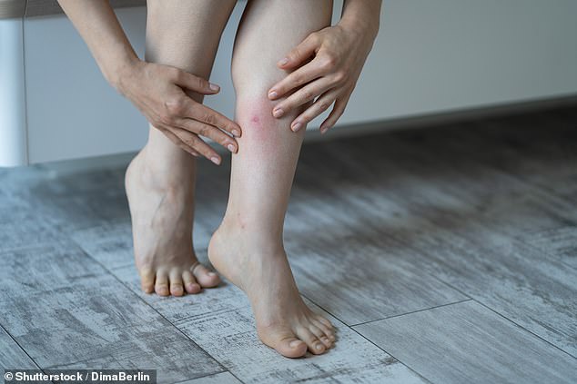 With thinner bedding and lighter clothing common in summer, Rhoedes says it's easier for bedbugs to access skin - and with millions of people checking in and out of hotels, guesthouses and Airbnbs, the risk of picking up an unwanted guest rises (Stock Image)