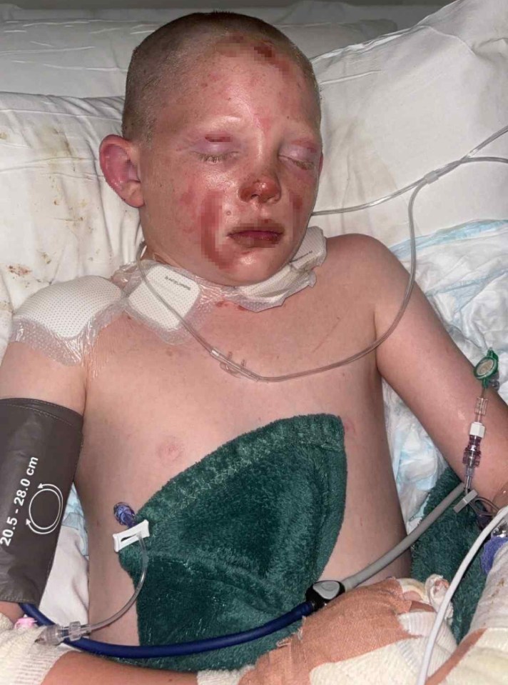 Boy with severe burns in a hospital bed.
