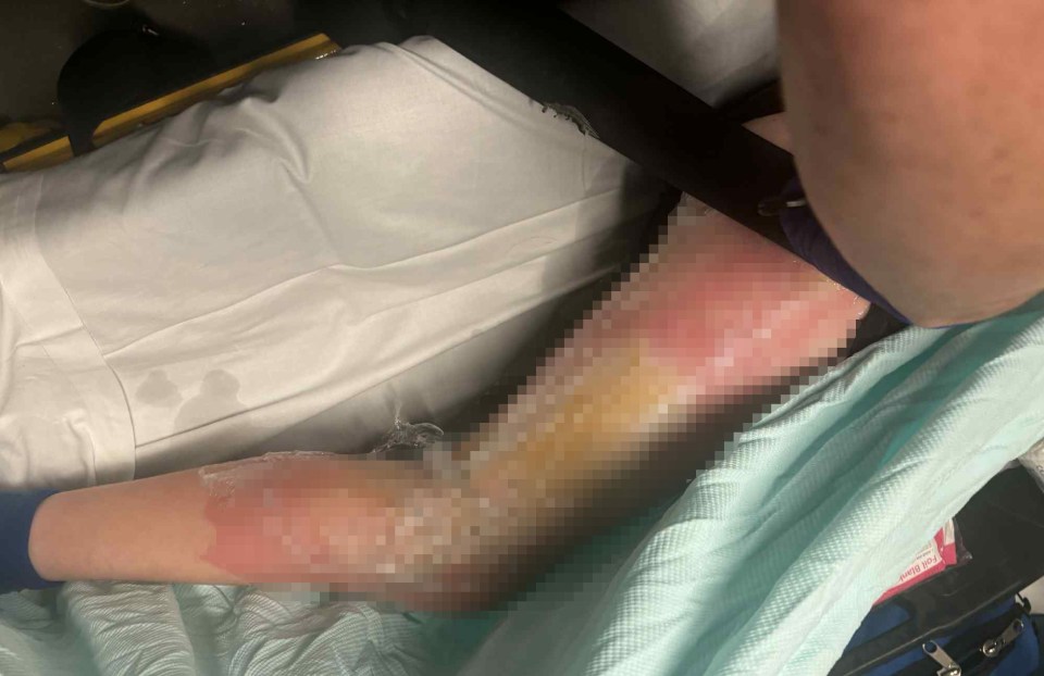 Severely burned leg wrapped in protective film.
