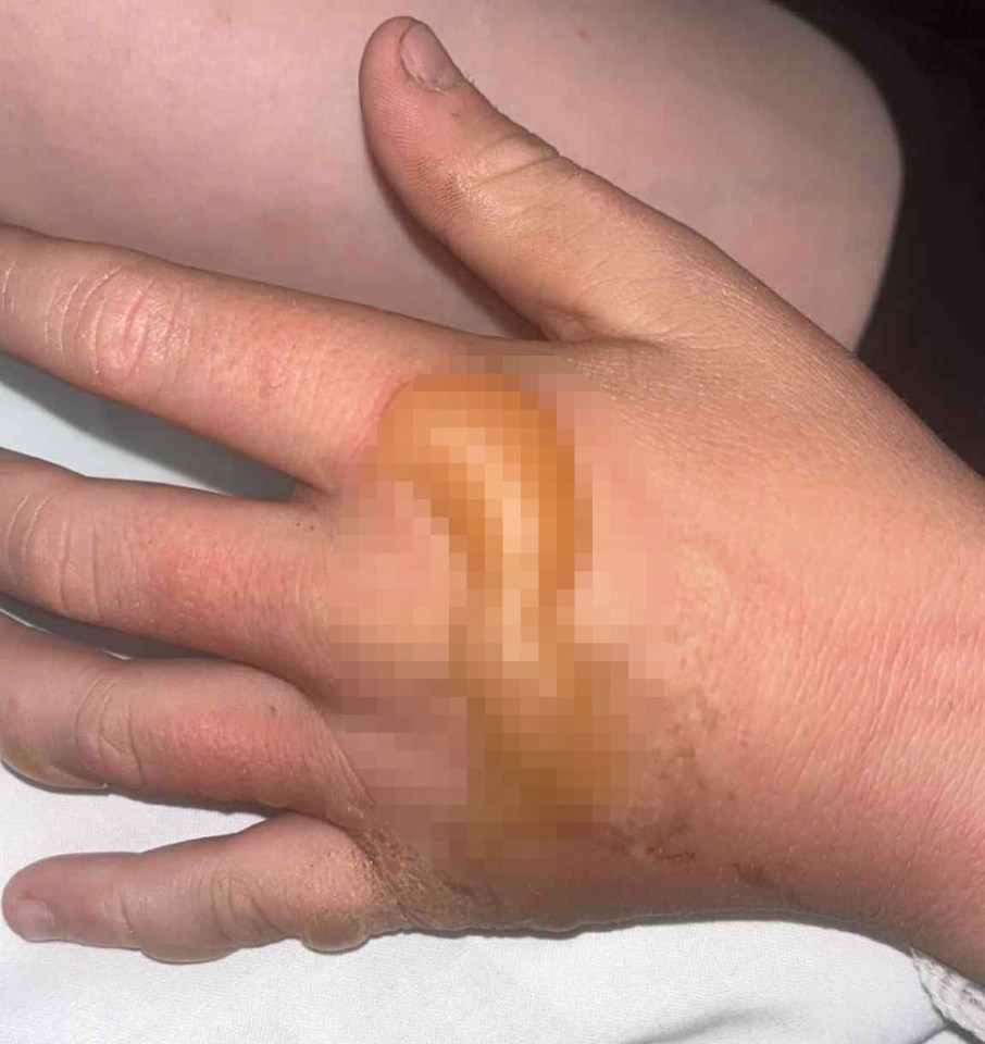 A large blister on a child's hand.