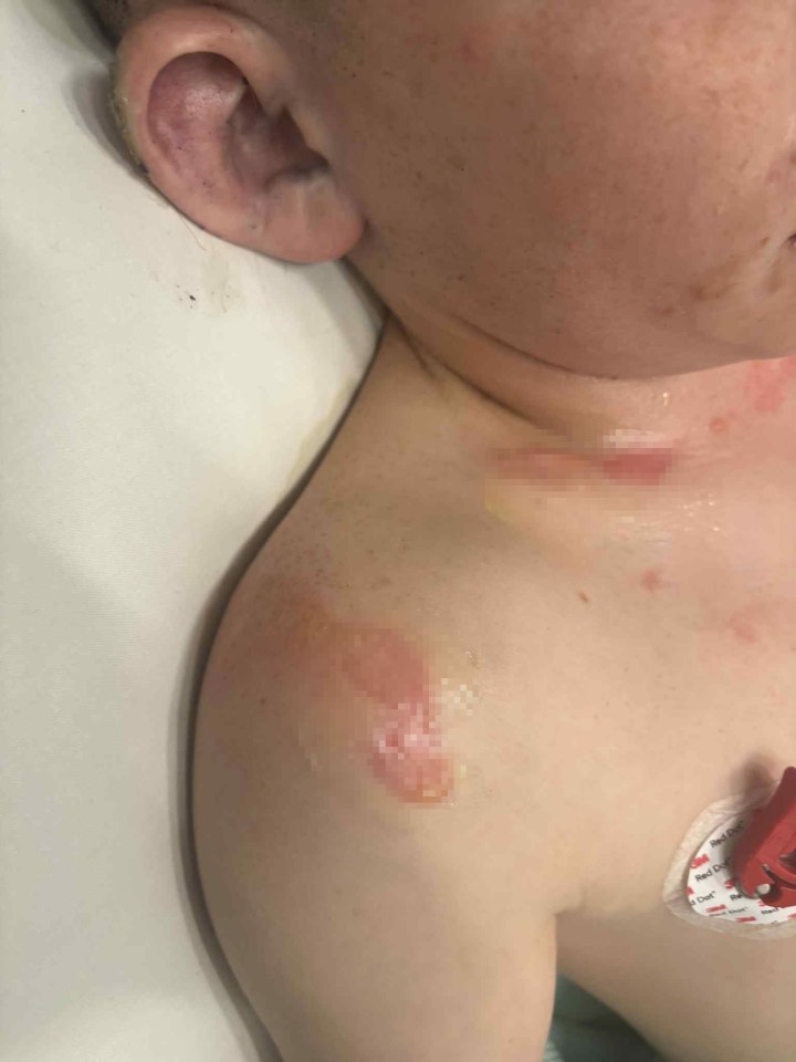Burn wounds on a boy's shoulder and neck.