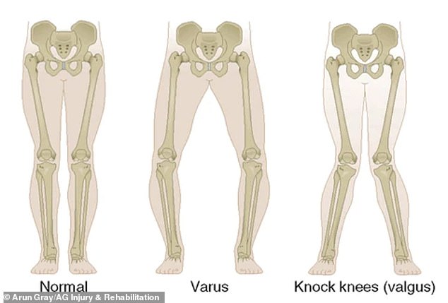 Arun Gray, a UK-based sports scientist and injury rehabilitation specialist, suspects Trump has a 'knock knee', formally known as bilateral knee valgus. Knock knee is a 'relatively common', especially among taller individuals and those with 'weaker glute muscles'