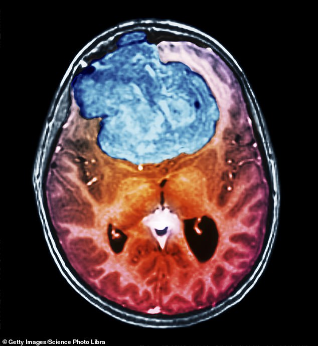 Meningiomas can cause vision loss, personality changes, memory loss and even paralysis. And while 70 per cent of patients are alive after ten years, between 10 and 20 per cent die within five years