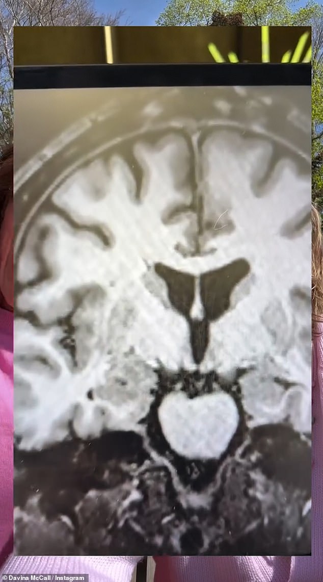 She had a six-hour operation to remove a 14mmm colloid cyst from her brain on November 15, after a health check discovered the tumour