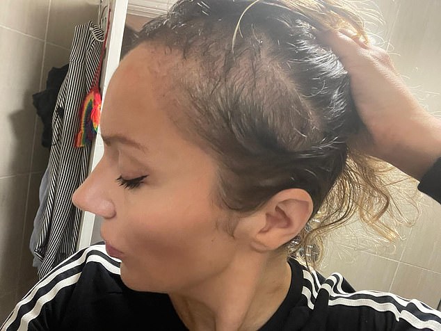 Katie was told that her hair follicles had died and a transplant would be her only option