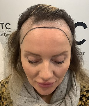 Hair can be seen starting to grow back