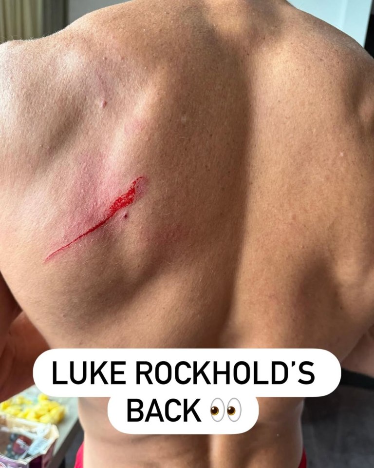 Luke Rockhold's back with a long scratch and bleeding.