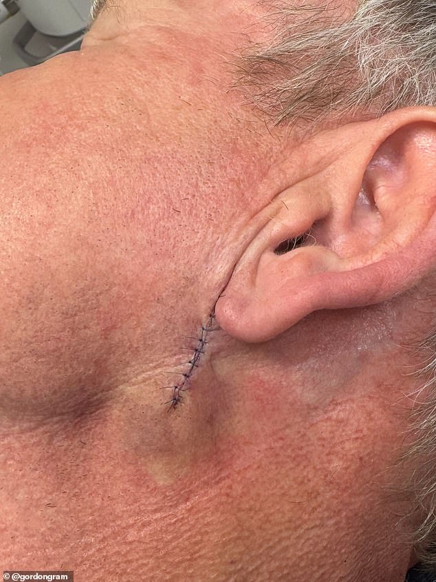 The TV chef shared pictures of his stitched up face on Instagram on Saturday and said he is 'grateful' for removing the cancer fast