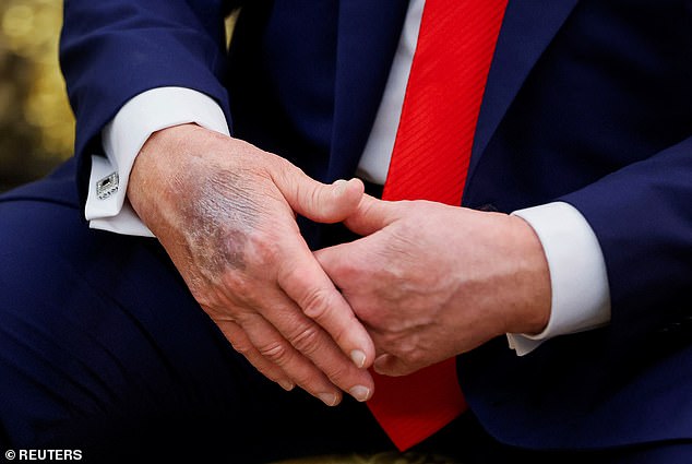 A mark on a hand of U.S. President Donald Trump is seen during a meeting at the White House. Karoline Leavitt said that Trump has been diagnosed with 'chronic venous insufficiency'