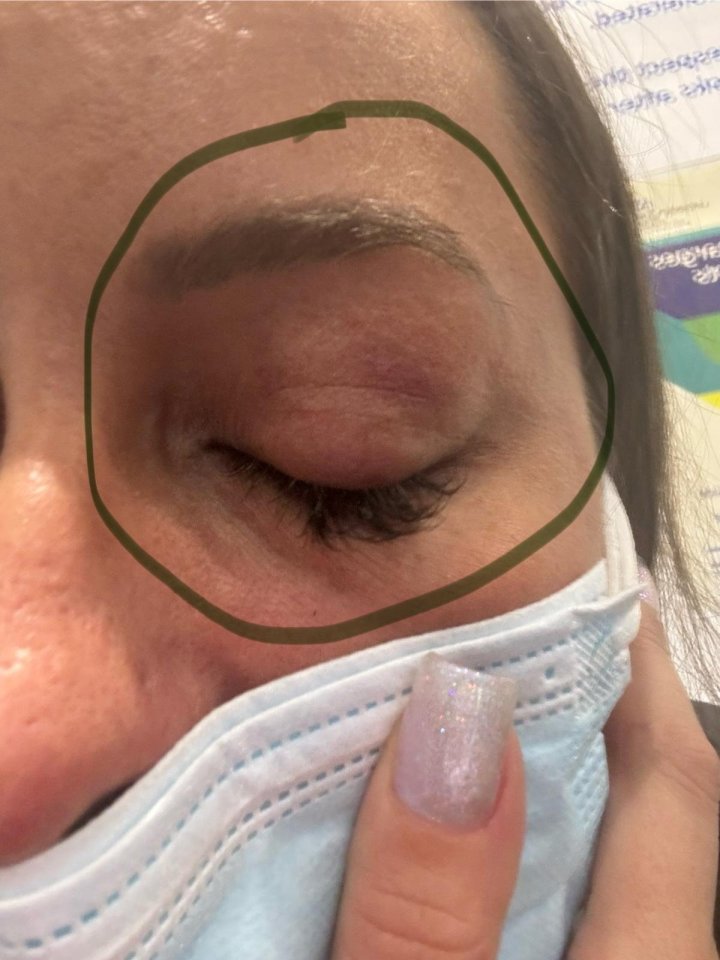 Close-up photo of a woman's eye showing bruising.