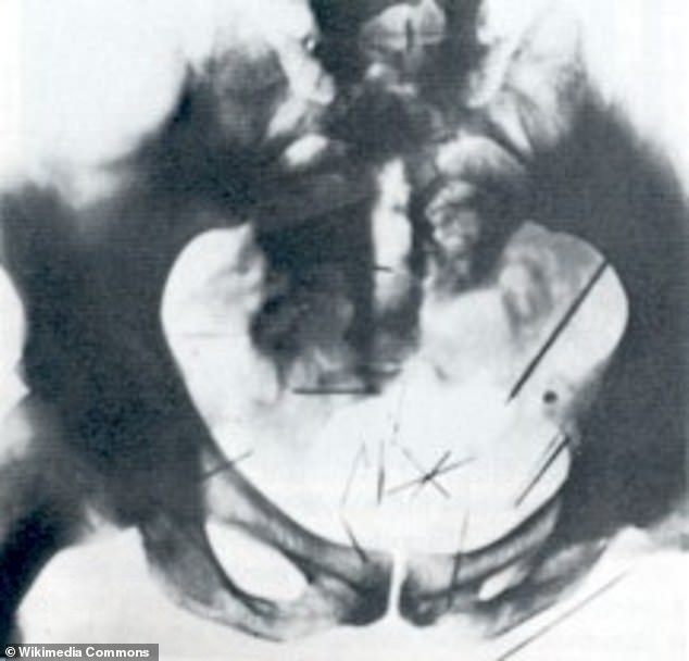 An X-ray of Fish's abdomen revealed how he stuck several needles into himself