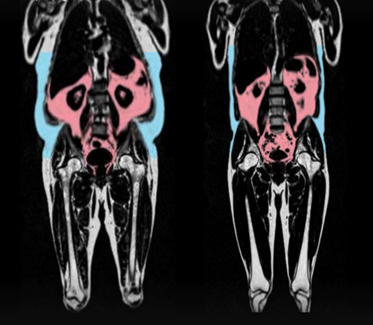 MRI scans showing body fat distribution.