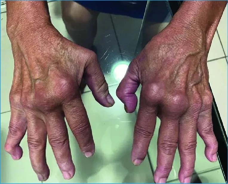Patient with joint deformities of the hands 6 years after confirmed chikungunya virus (Credit: SehatHub)