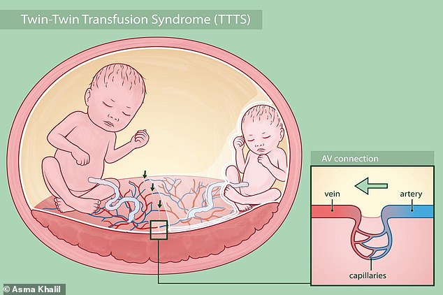 TTTS is a rare but life-threatening condition that affects 10 to 15 per cent of identical twins that share a placenta (monochorionic twins)